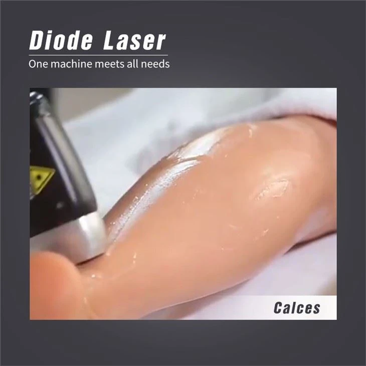 Permanent 808nm Diode Laser Soprano Titanium Hair Removal Machine