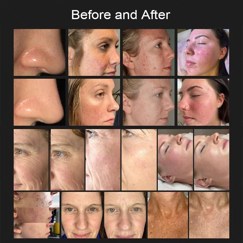 Cold Plasma Skin Rejuvenation System high quality