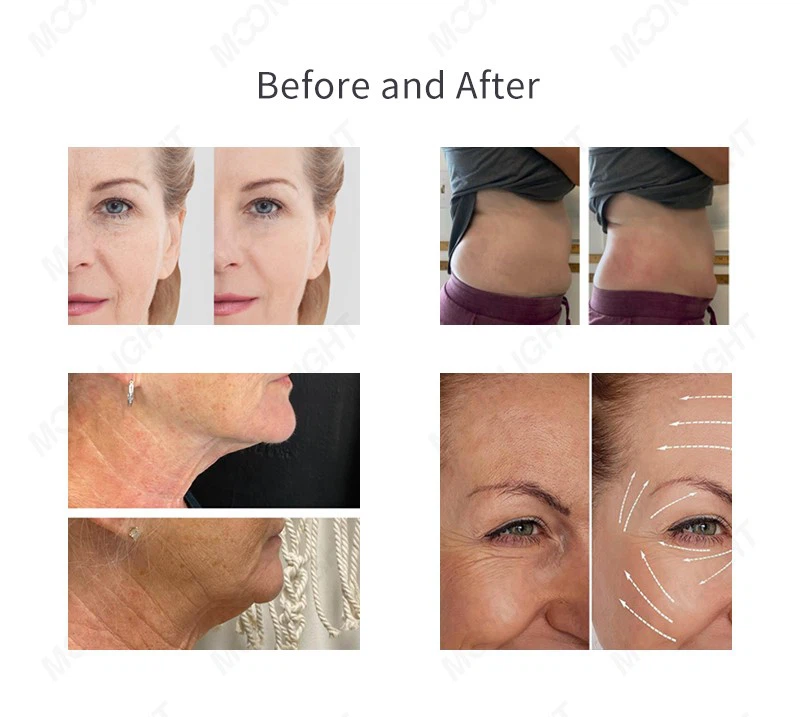 MNLT Cryoskin 4.0 Slimming Machine